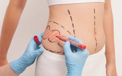 liposuction---yag-aldirma-2021-06-07_13-28-12-05739550383024574