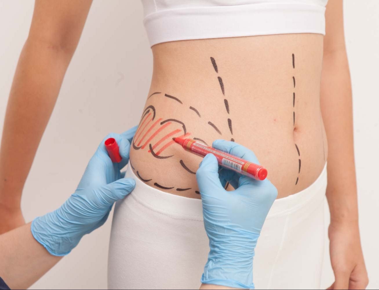 liposuction—yag-aldirma-2021-06-07_13-28-12-05739550383024574 liposuction---yag-aldirma-2021-06-07_13-28-12-05739550383024574